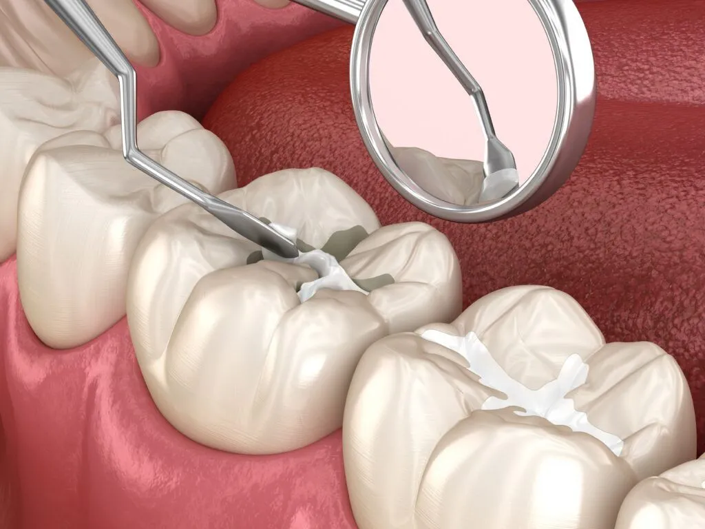 Understanding the Different Types of Dental Fillings