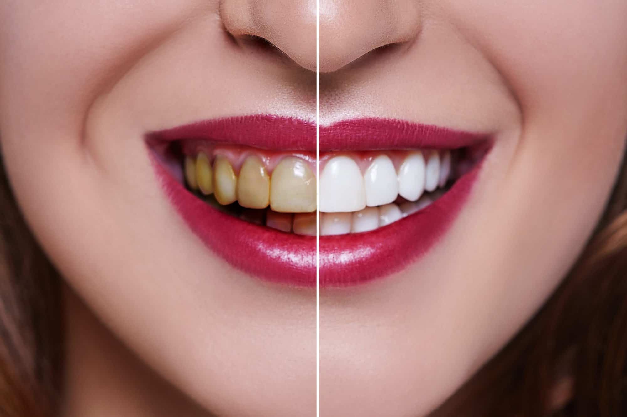 The Science Behind Teeth Whitening: How Does It Work?